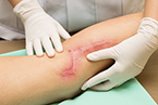 scar surgery