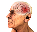 Parkinson's disease