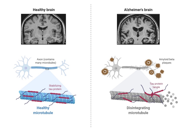 Pathology of Alzheimer's Disease